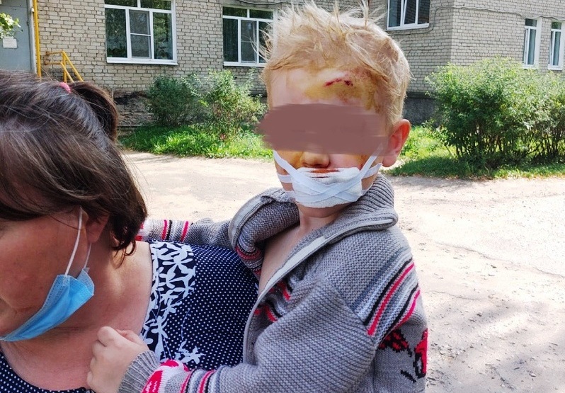 Собака покусала 3-летнего ребёнка в Костромской области