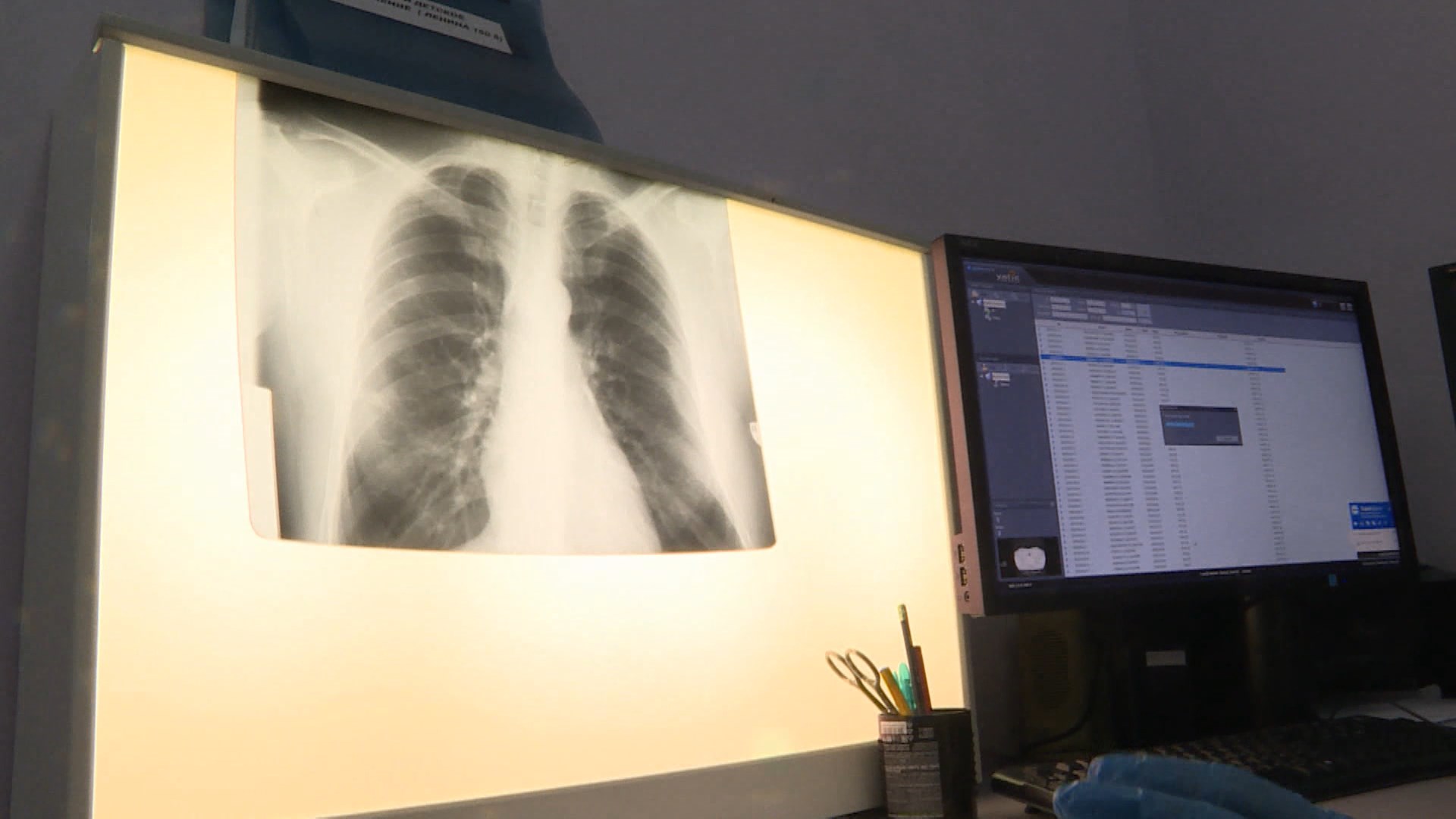 У первоклассника в Костроме выявлен туберкулёз 