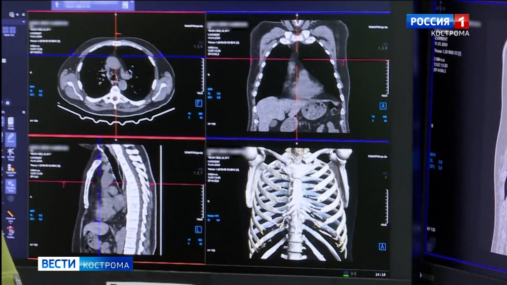 В Городскую больницу Костромы поступил новый компьютерный томограф